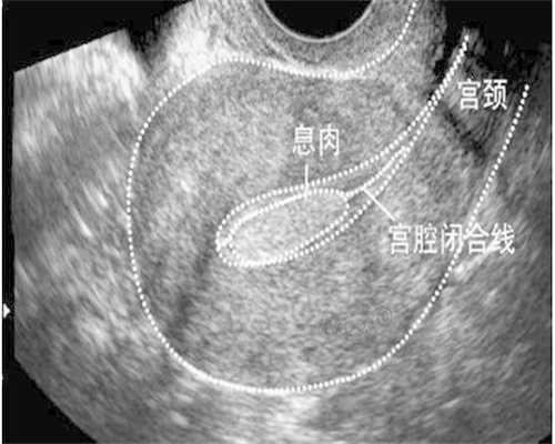 北京高龄备孕|子宫内膜厚难怀孕，我的真实经验分享